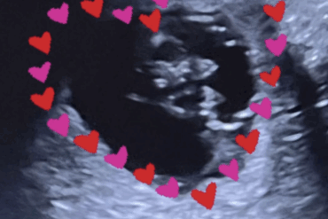 Ultraschall Trächtigkeit